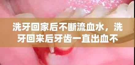 洗牙回家后不断流血水,洗牙回来后牙齿一直出血不止怎么办